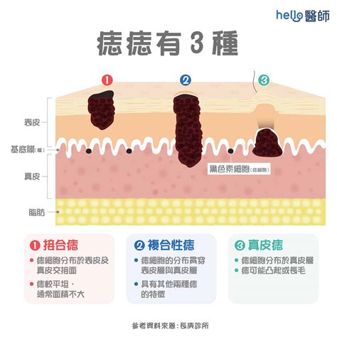 為甚麼會長痣|痣形成的原因？痣長毛、痣變多變大是痣病變？5招判別